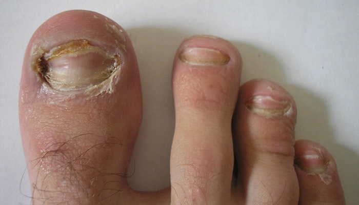poate ciuperca de toenail provoacă pierderea în greutate)